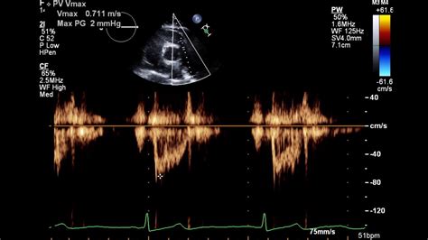 2d echo normal result sample|Two.
